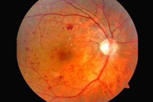 Read more about the article Preserving Your Vision: The Vital Role of Diagnostic Testing for Diabetic Eye Disease