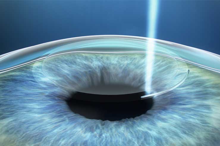 You are currently viewing Clear Vision Awaits: The Power of Laser Vision Consultation