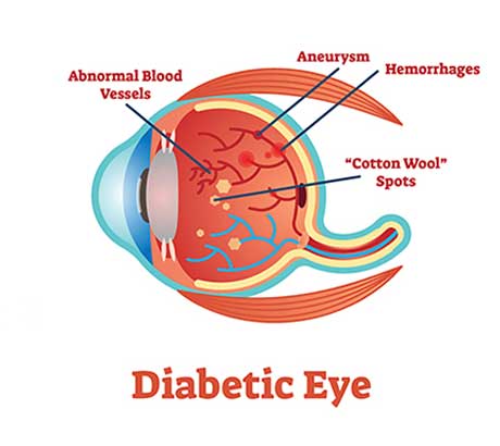 Diabetic-Eye-Disease