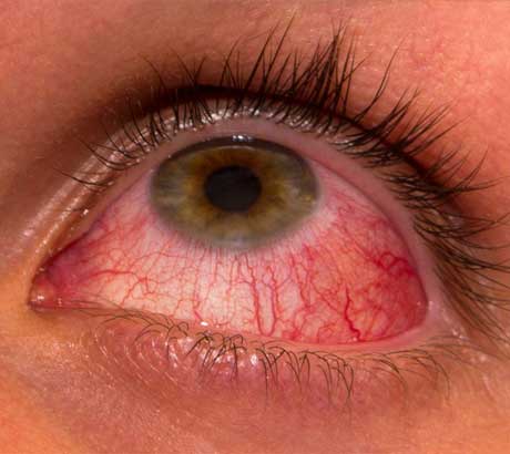 Eye-Infection-Diagnosis